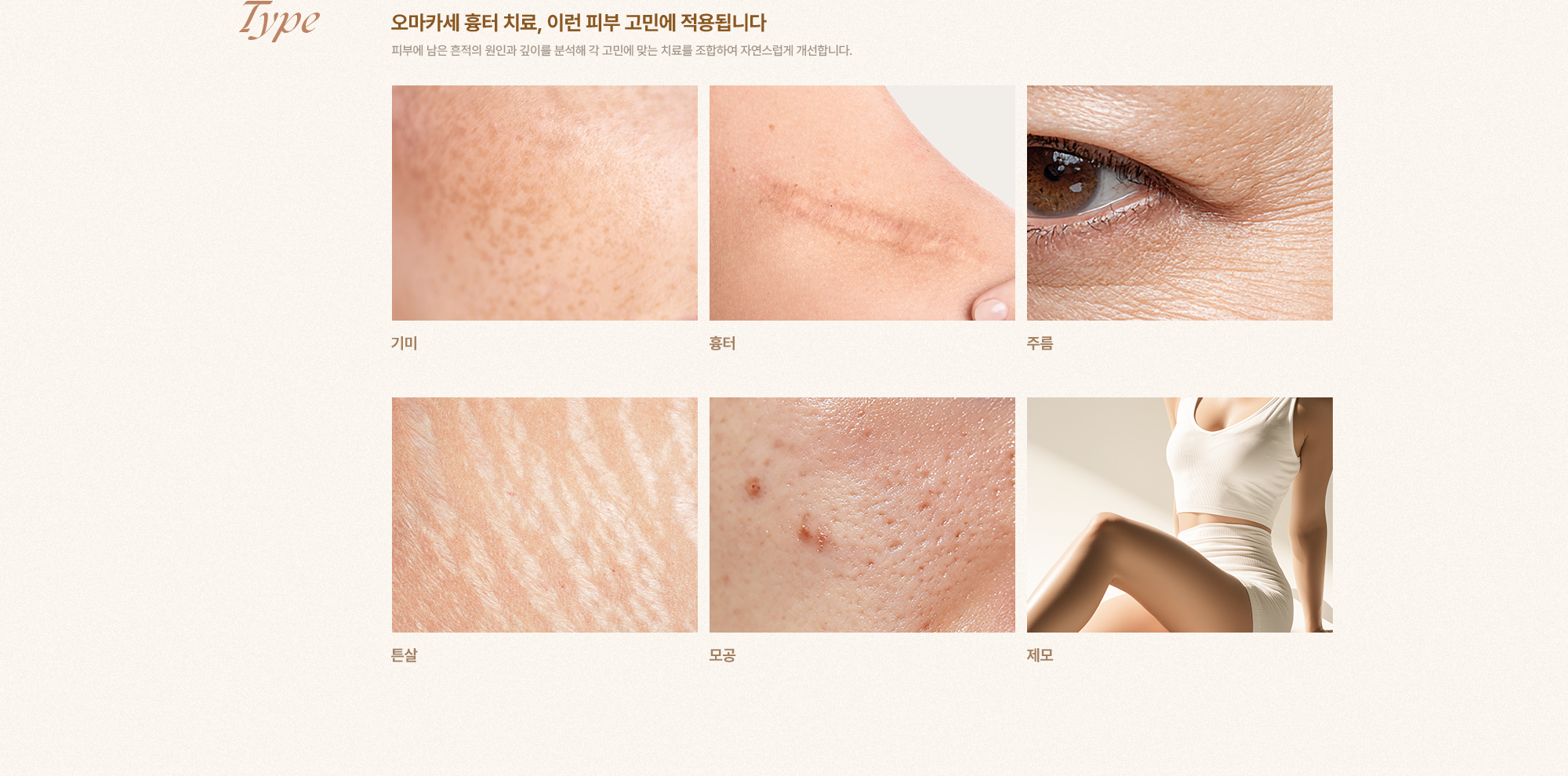 [Type] [오마카세 흉터 치료, 이런 피부 고민에 적용됩니다] 피부에 남은 흔적의 원인과 깊이를 분석해 각 고민에 맞는 치료를 조합하여 자연스럽게 개선합니다. [기미] [흉터] [주름] [튼살] [모공] [제모]